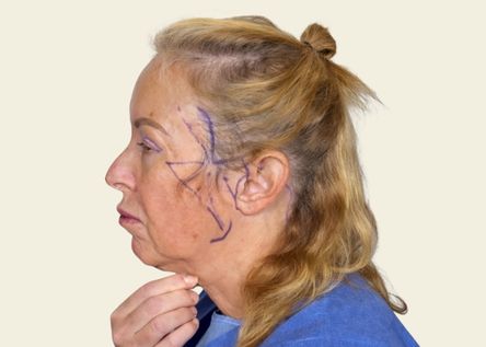 What Is Deep Central Neck Contouring?