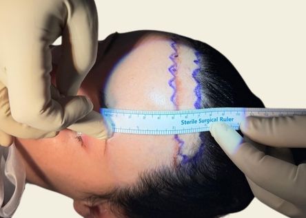 What is Forehead Reduction?