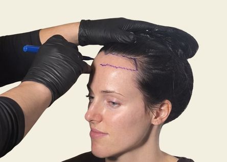 Is forehead reduction right for you?