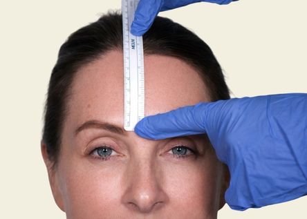 Benefits of Forehead Reduction Surgery