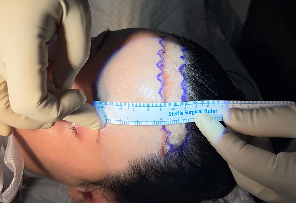 What is Forehead Reduction?