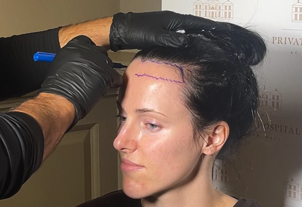 Is forehead reduction right for you?